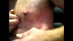 Nails removd from nipples Thumb