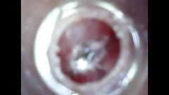 Camera in uretra 2 Thumb
